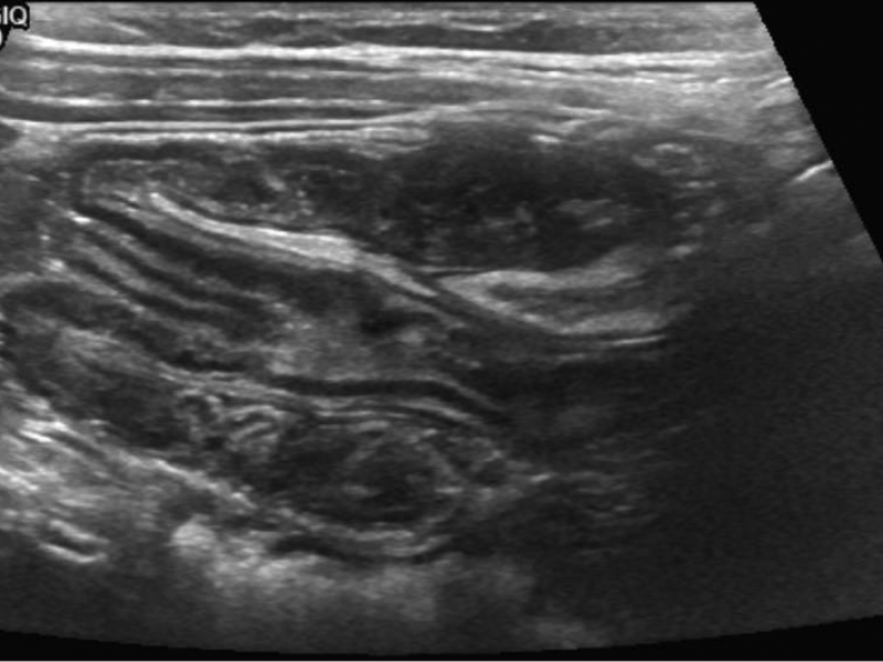 Imaging Case: 2 Year Old Male With Abdominal Pain