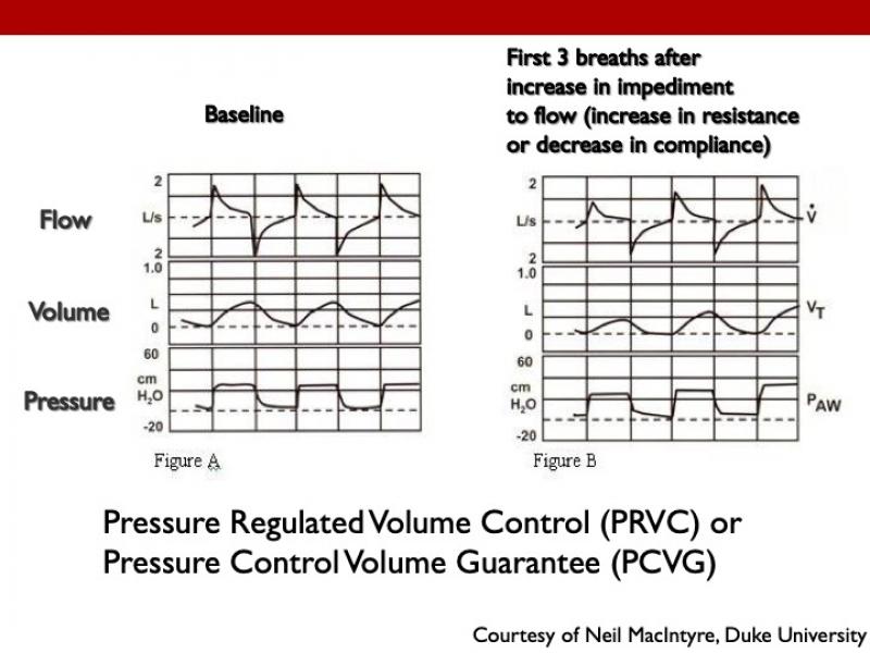Pressure regulated volume control (PRVC): Is it a “volume control” or “pressure control” breath?