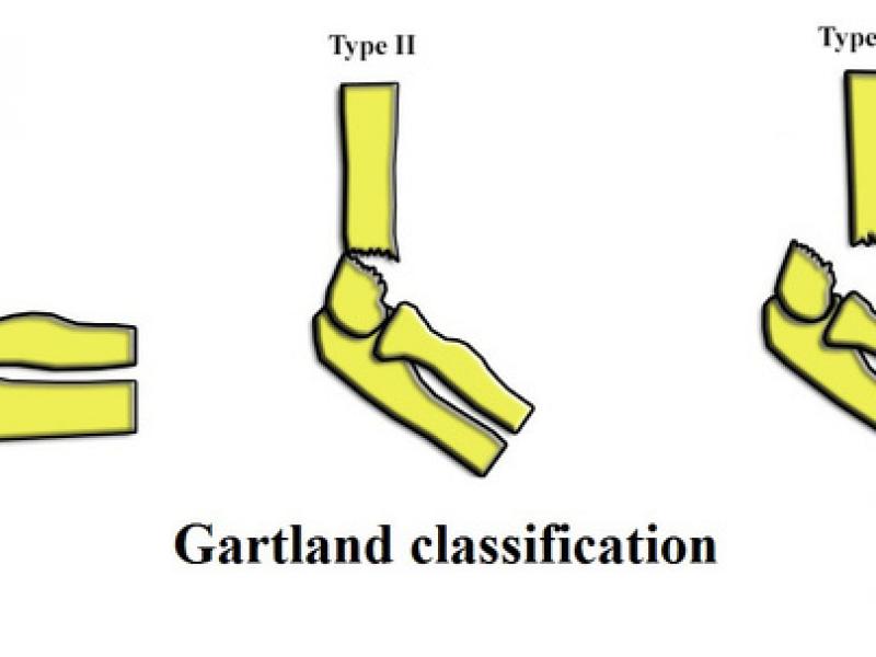 The Must-Know Complications of Supracondylar Fractures