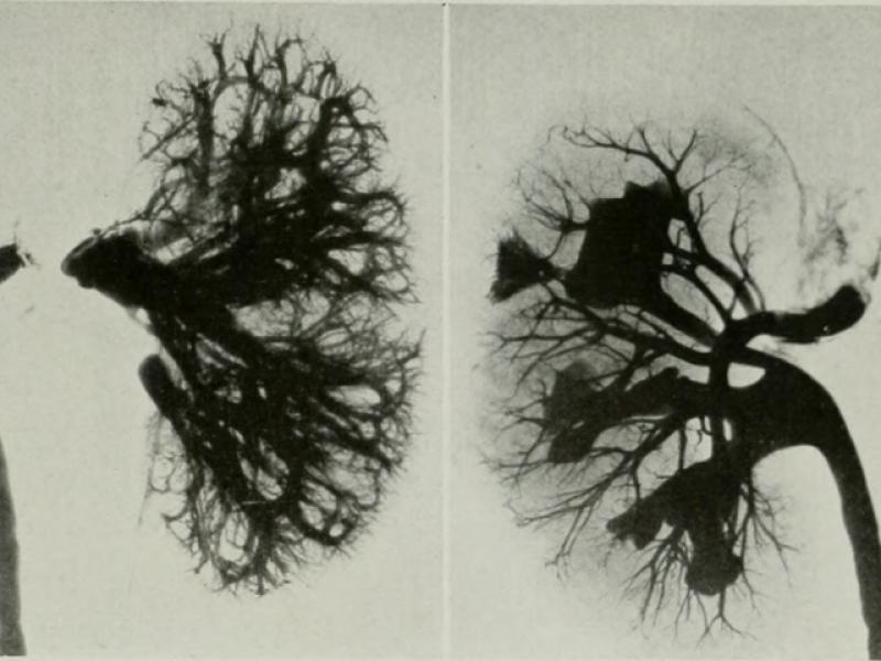 Dialysis Disequilibrium Syndrome