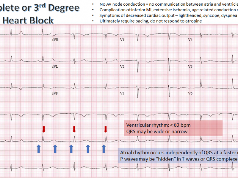 Back to Basics: Complete Heart Block