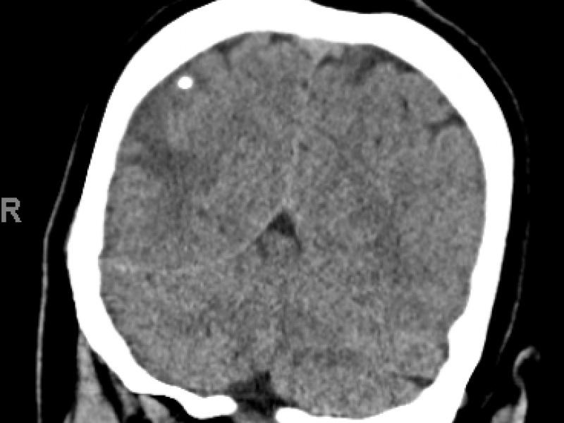Imaging Case: Woman With Altered Mental Status
