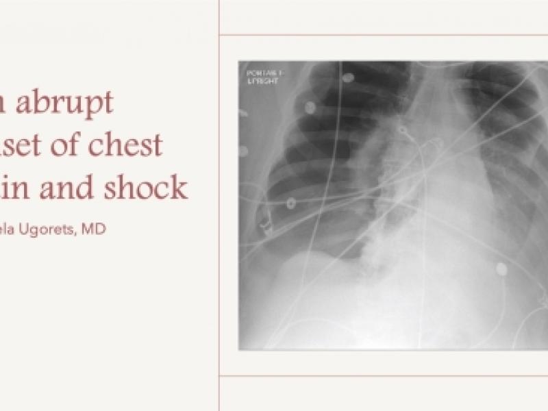 An abrupt onset of chest pain and shock