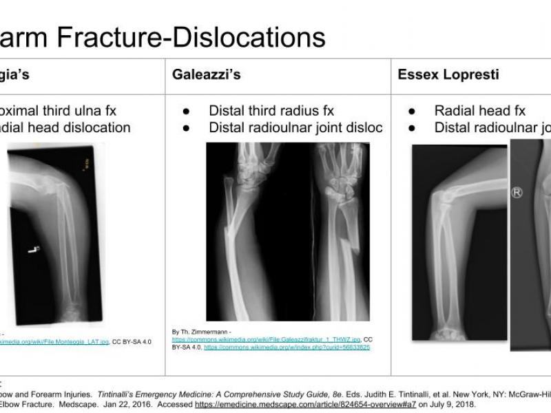 Back to Basics:  Forearm Fracture-Dislocations
