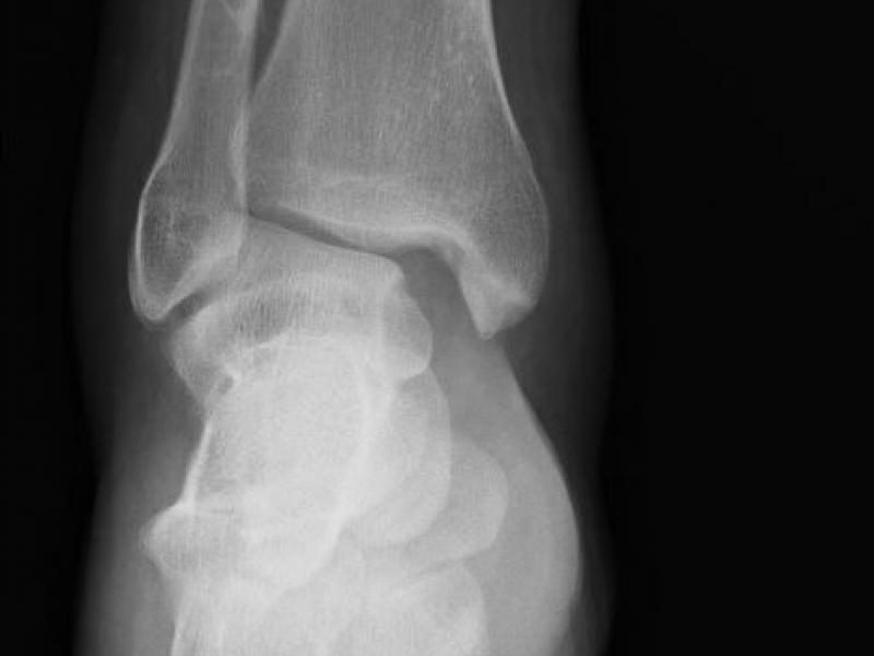 Critical Cases - Ankle dislocation!!