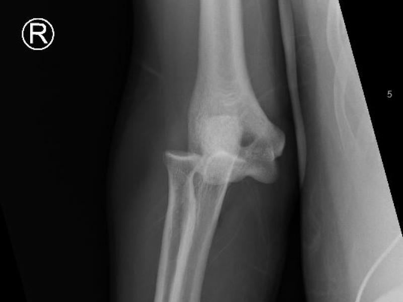 Critical Cases - Elbow Dislocation!