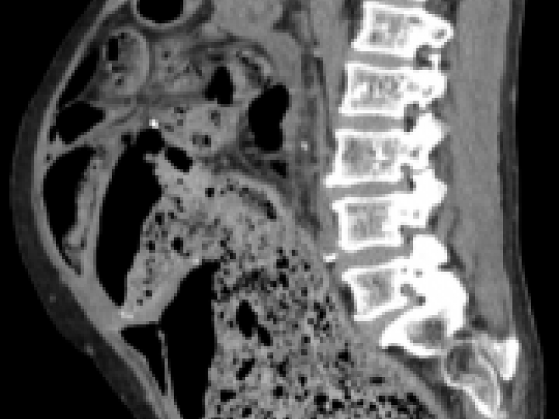 Advanced Practice: Stercoral Colitis with Obstructive Acute Kidney Injury
