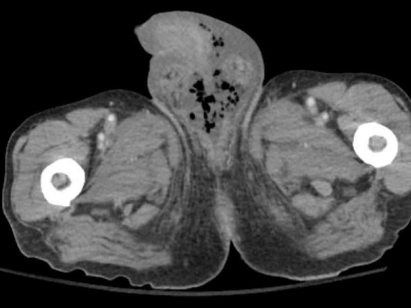 Imaging Case: 74 Year Old Male with Rectal Pain and Fatigue