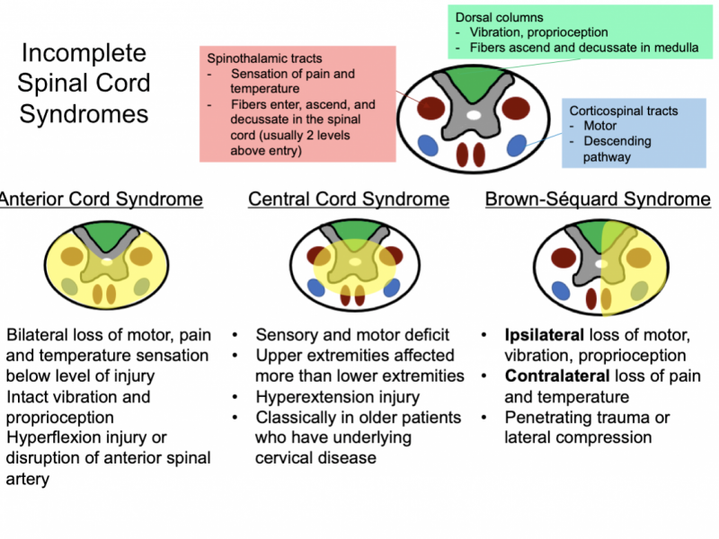 Back to Basics: Incomplete Spinal Cord Syndromes