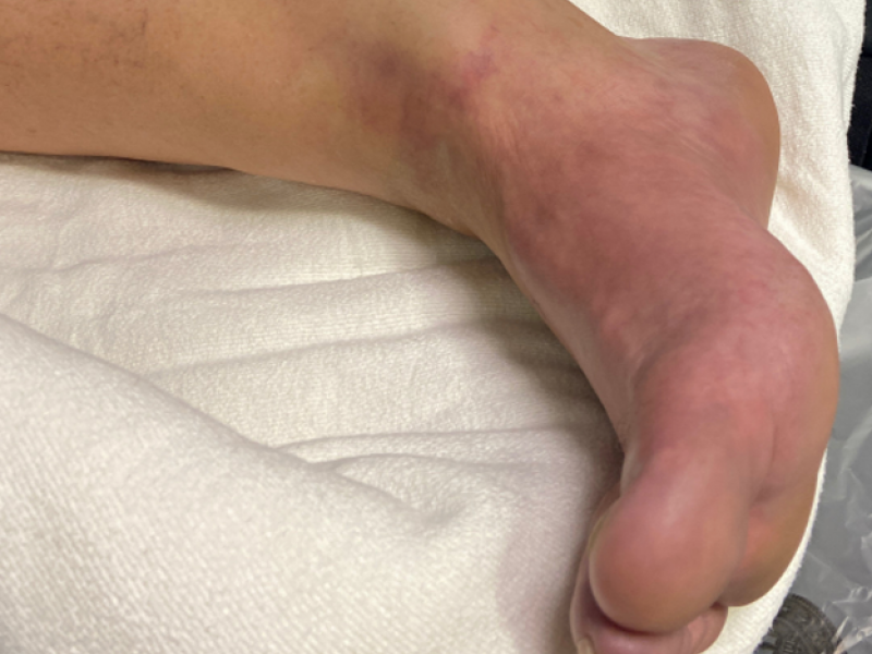 Back to Basics: Ankle Injury